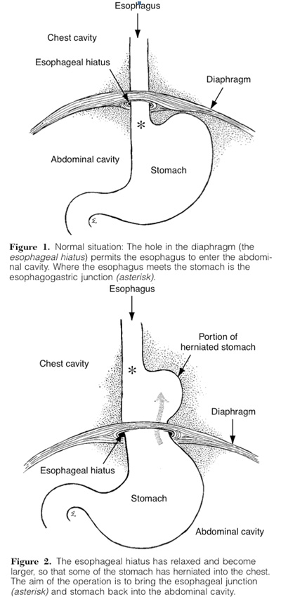 stomach cancer or gerd
