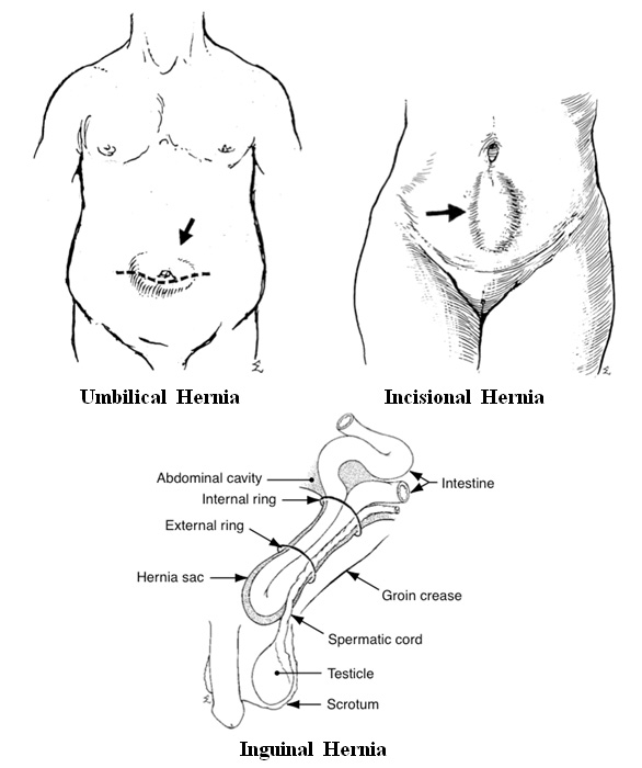 Hillswest Specialists Westmead | Lap Band Surgeons | Hernia